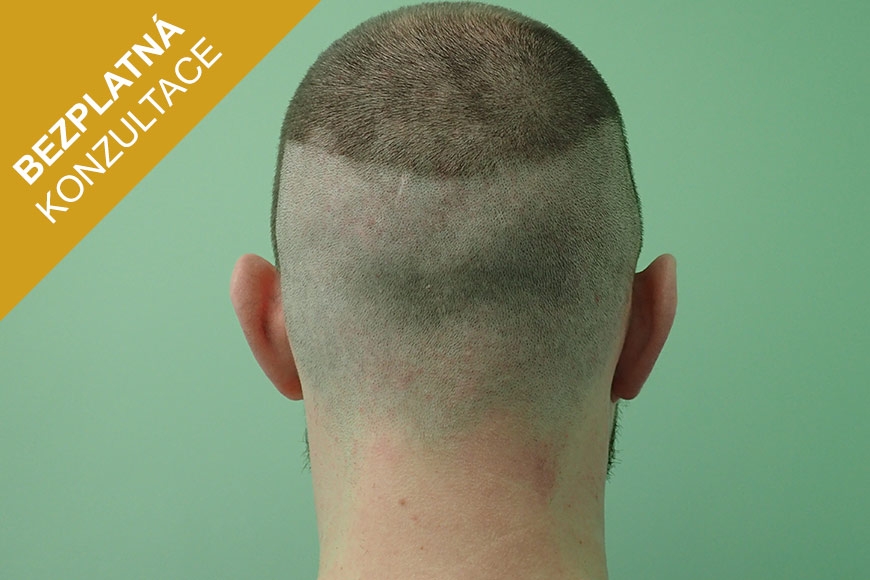 Transplantace vlasů FUE